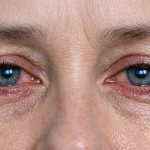 eye strain vs dry eyes