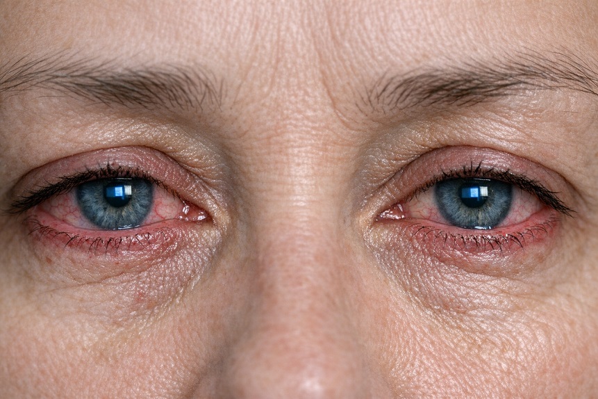 eye strain vs dry eyes